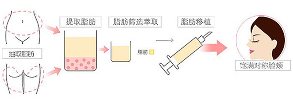 自體脂肪豐太陽(yáng)穴