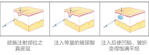 注射豐太陽穴