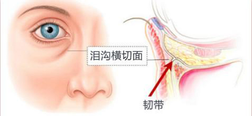 自體脂肪填淚溝