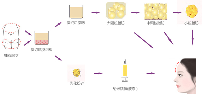 自體脂肪豐額頭