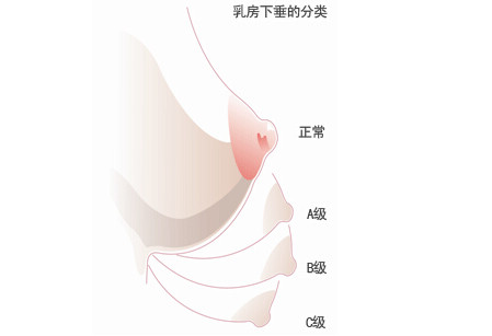 乳房下垂矯正