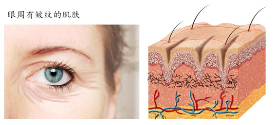 眼部除皺