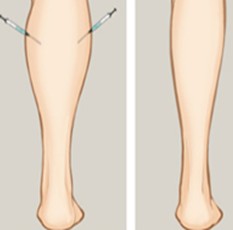注射瘦小腿